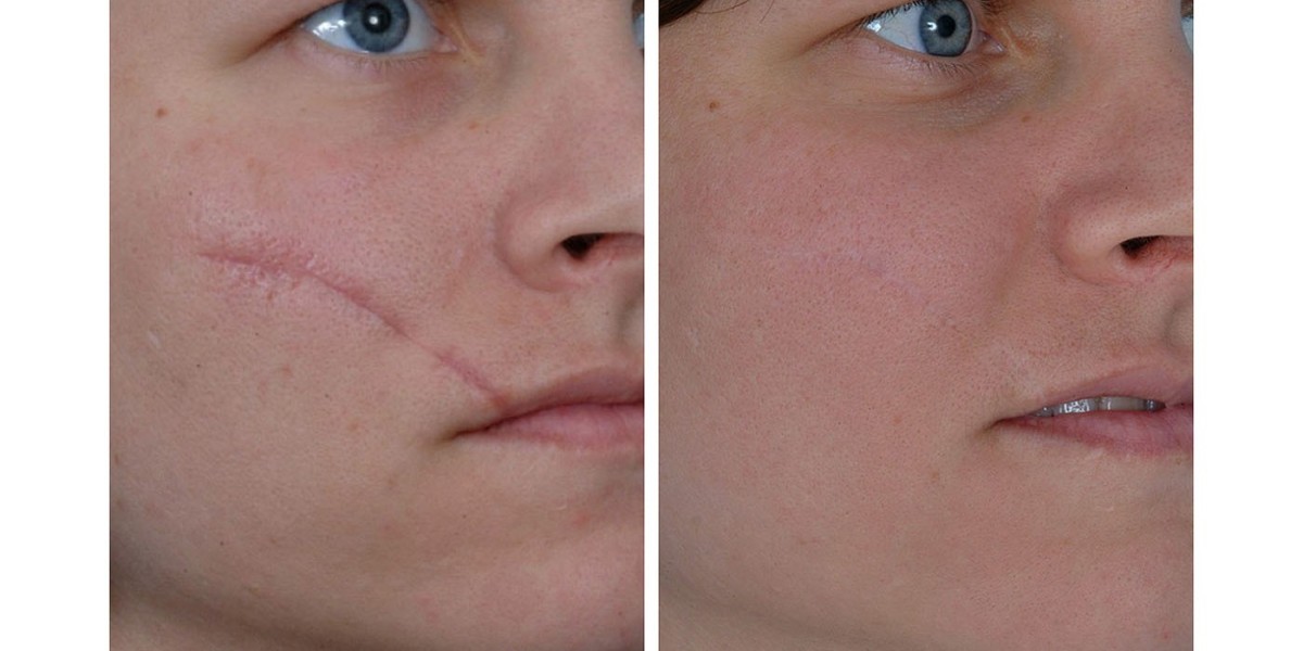 Finding the Right Clinic for Laser Scar Removal in Riyadh