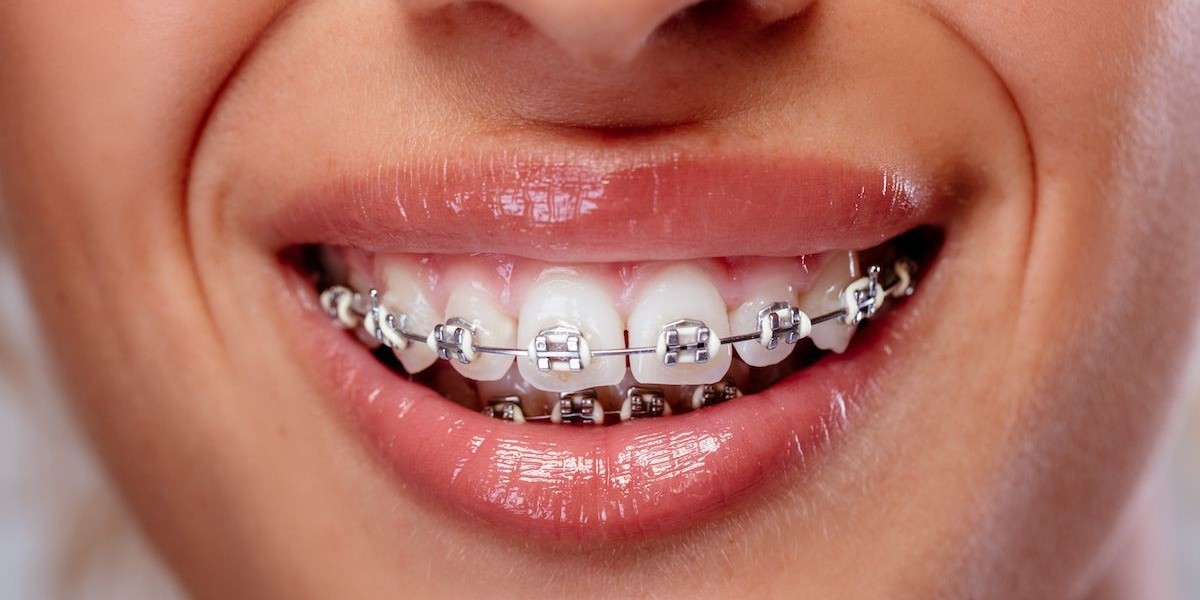 Invisalign in Dubai: What’s Included in the Treatment Price?
