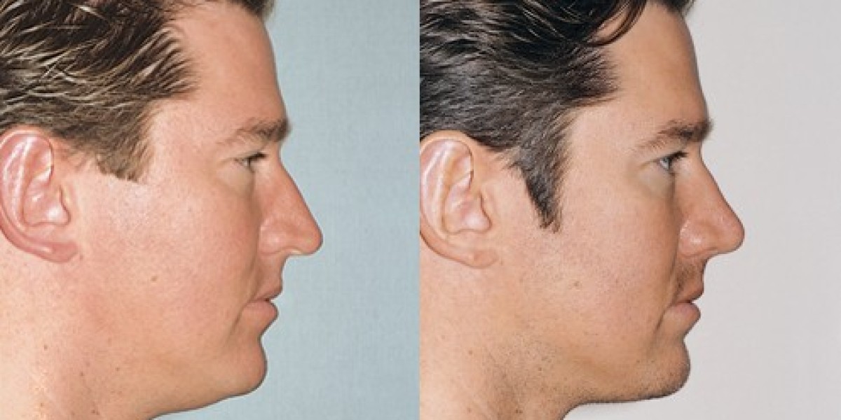 How Rhinoplasty Achieves Natural and Lasting Results