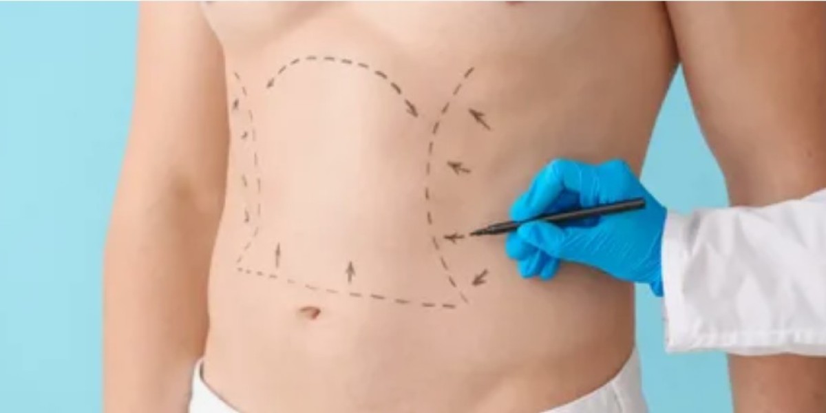 Understanding the Liposuction Process in Riyadh: A Step-by-Step Guide