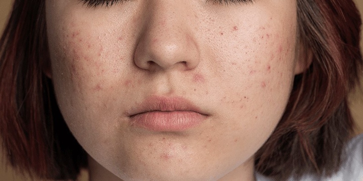 How to Avoid Side Effects During Acne Treatment