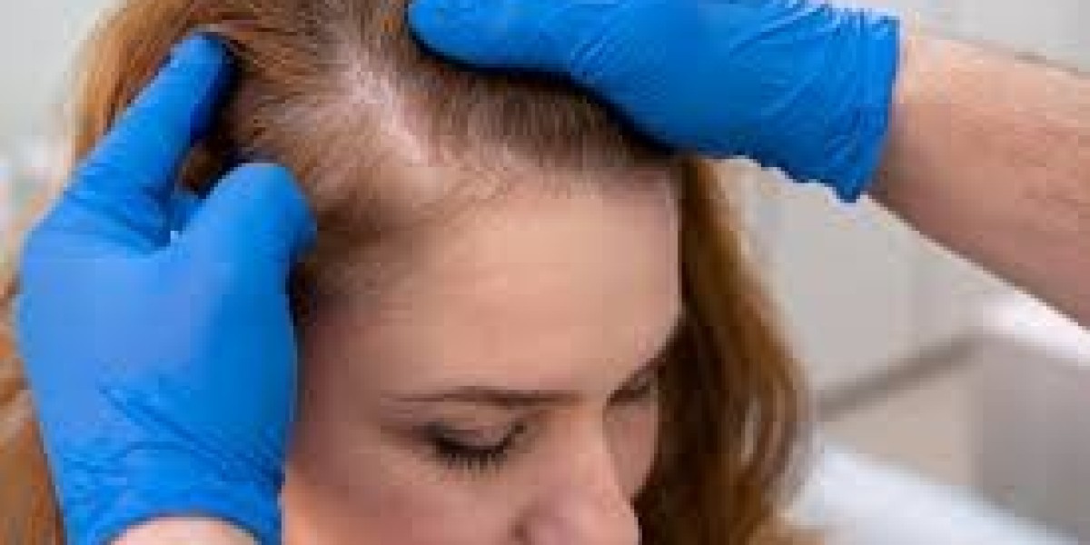 Finasteride: The Silent Hero in Hair Loss Treatment in Dubai