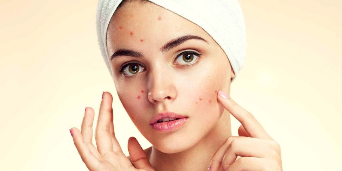 Pimple Treatments for Teenagers in Riyadh: Tips and Options please write 700 words on this