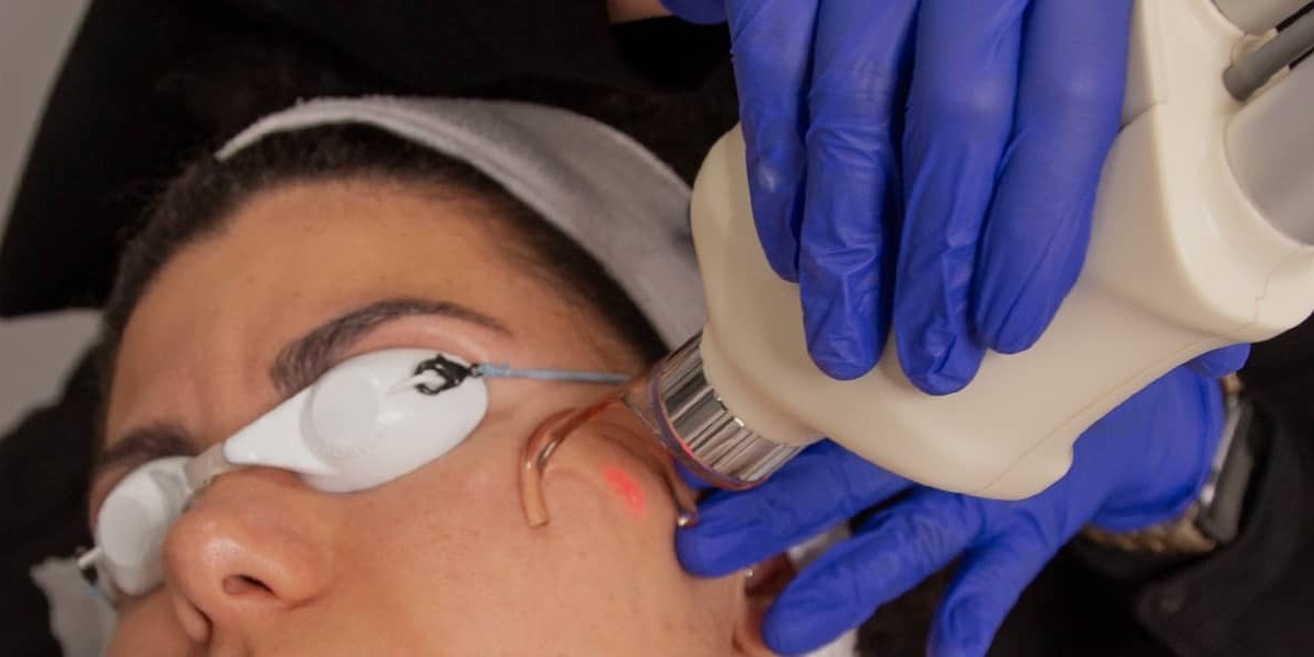 Can Fractional CO2 Laser Treat Sunspots? The Answer Might Surprise You