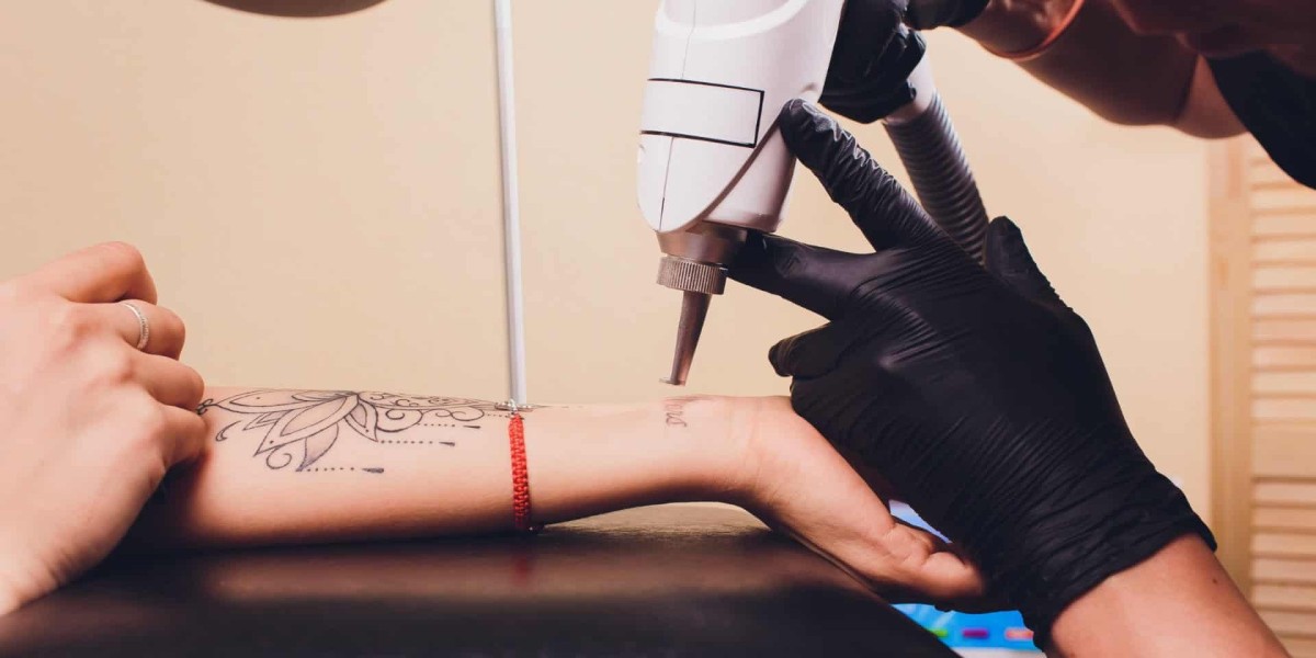 What Are the Most Common Misconceptions About Laser Tattoo Removal