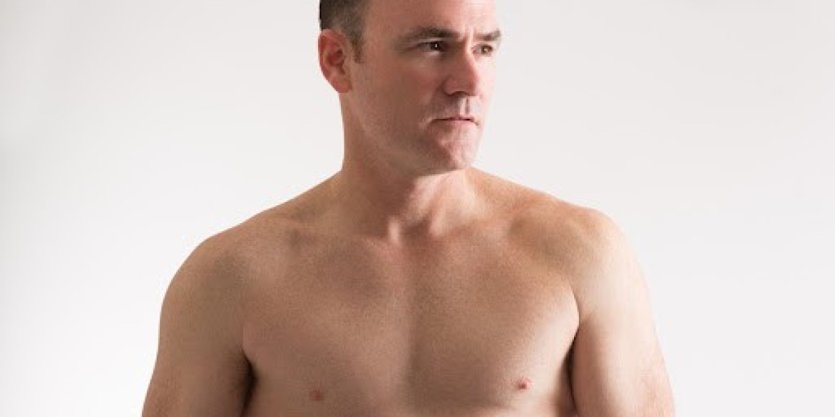Is Gynecomastia a Genetic Condition or Caused by Lifestyle?