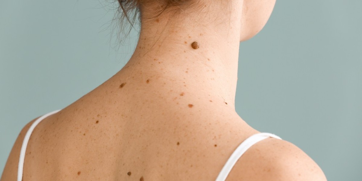 Is Mole Removal on Body the Right Choice for You?