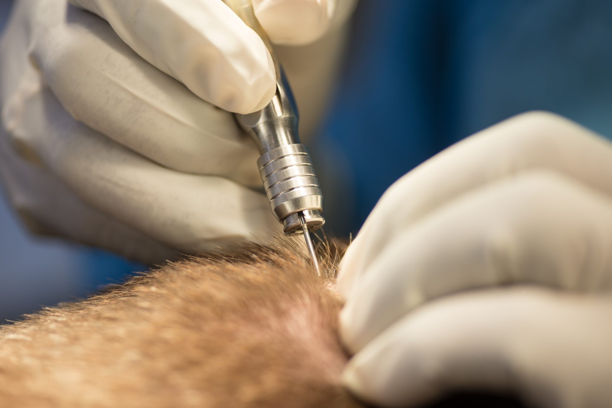 Hair Transplant in Dubai