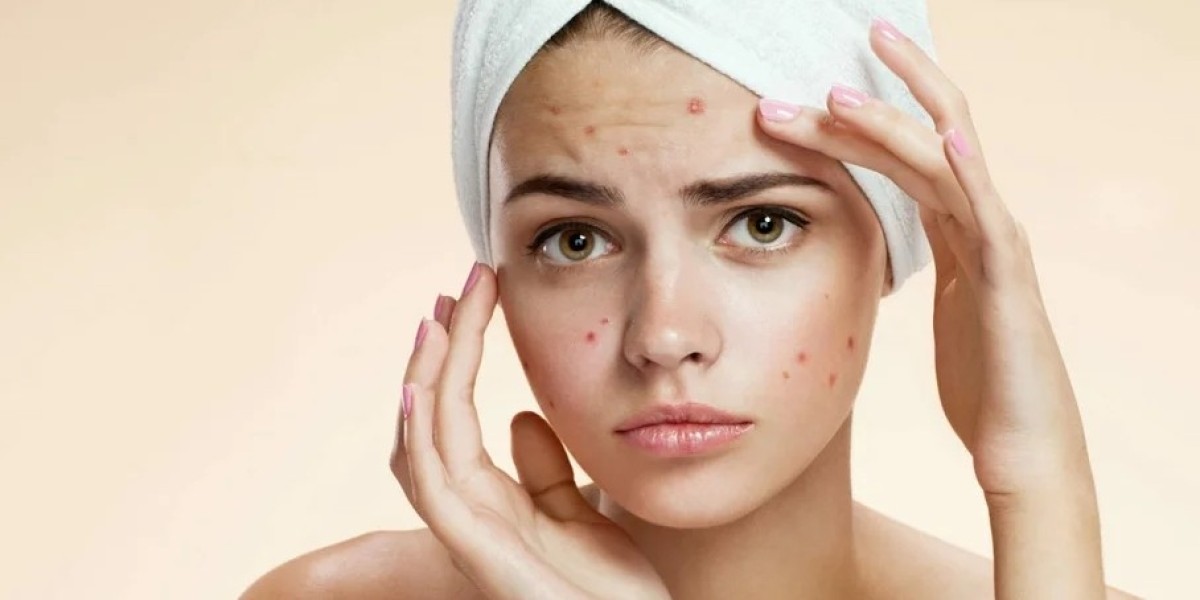 Custom Skincare Plans for Pimples Offered in Riyadh Clinics