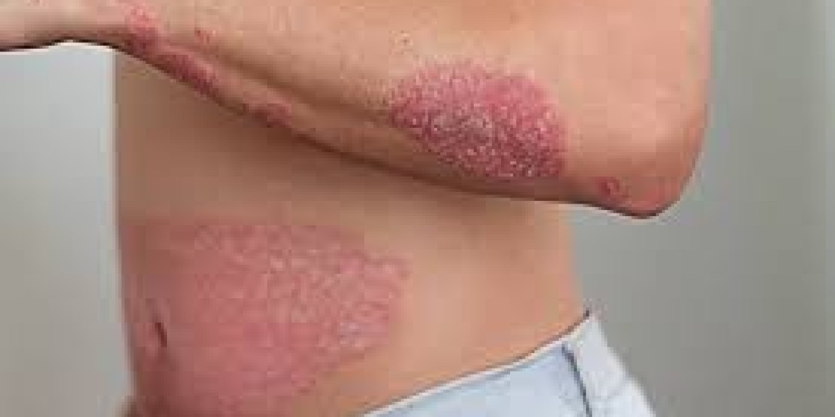 The Role of Skin Infection Antibiotics in Modern Skincare