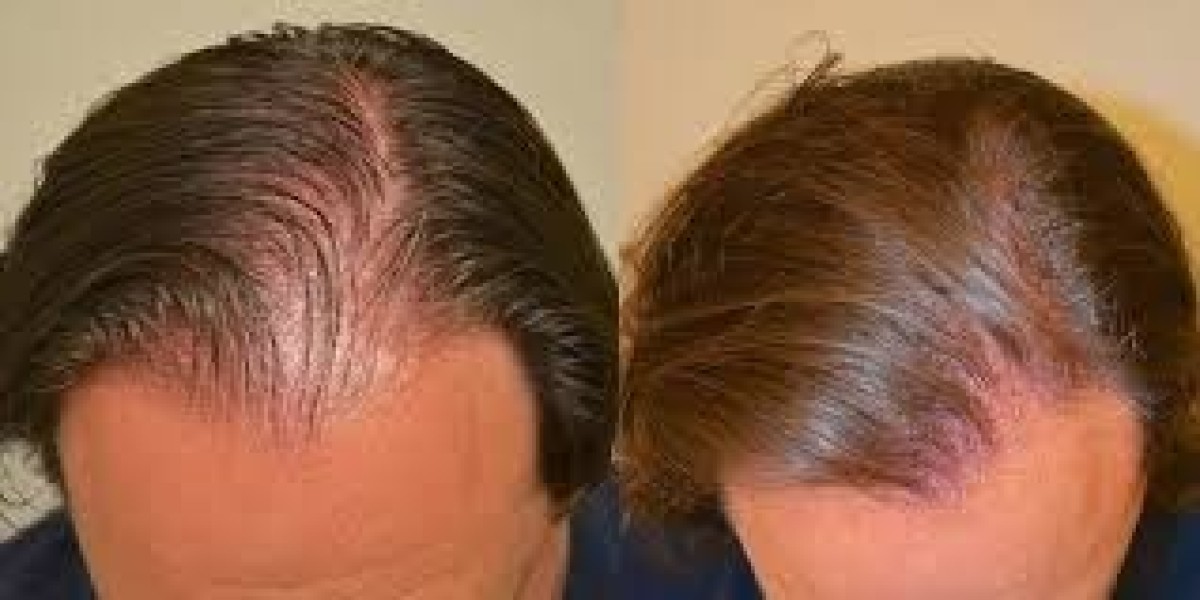 The Science Behind Finasteride and Hair Regrowth