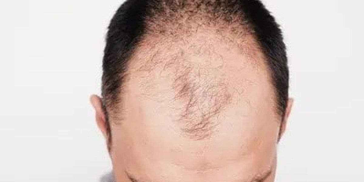 What Influences the Cost of Hair Transplants in Dubai?