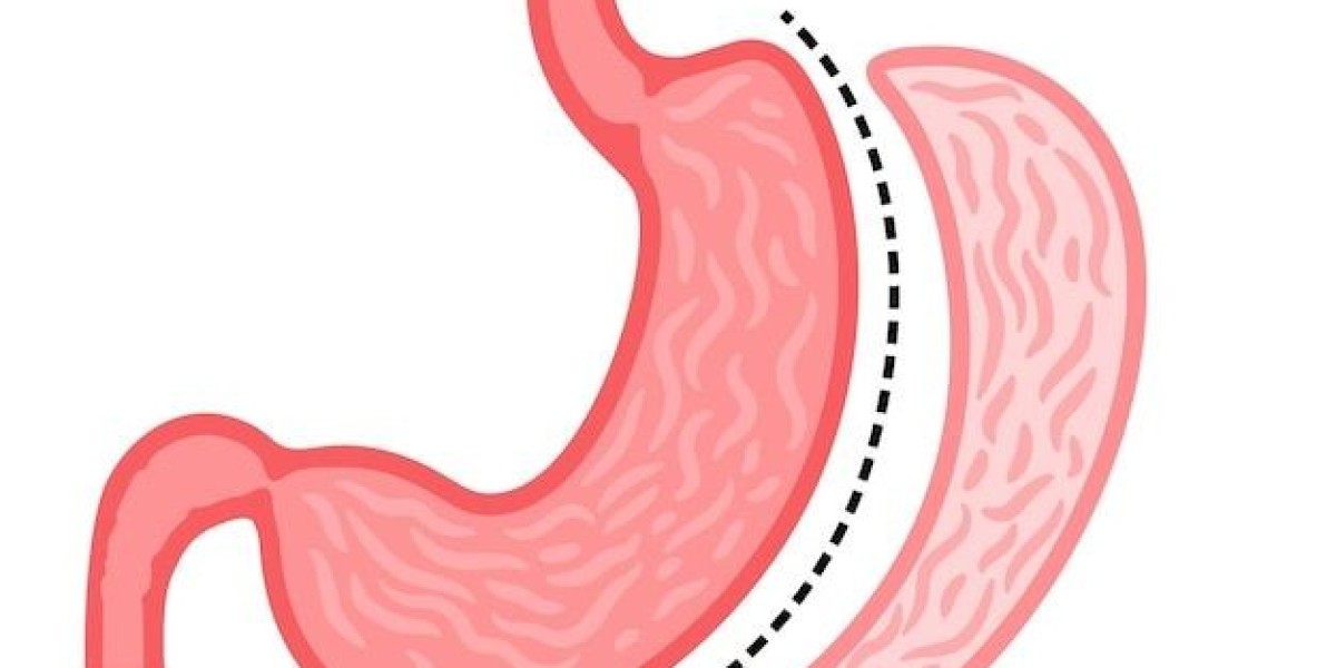 Comparing Laparoscopic Sleeve Gastrectomy Costs in Riyadh Clinics