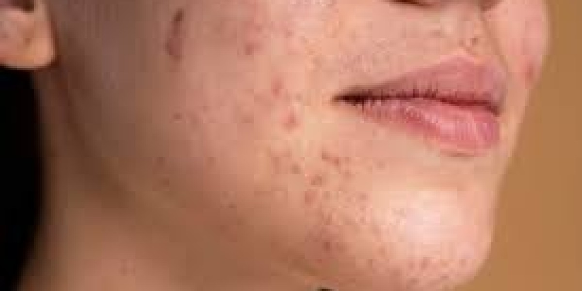 Exploring Treatment Options: Mild to Severe Acne Explained
