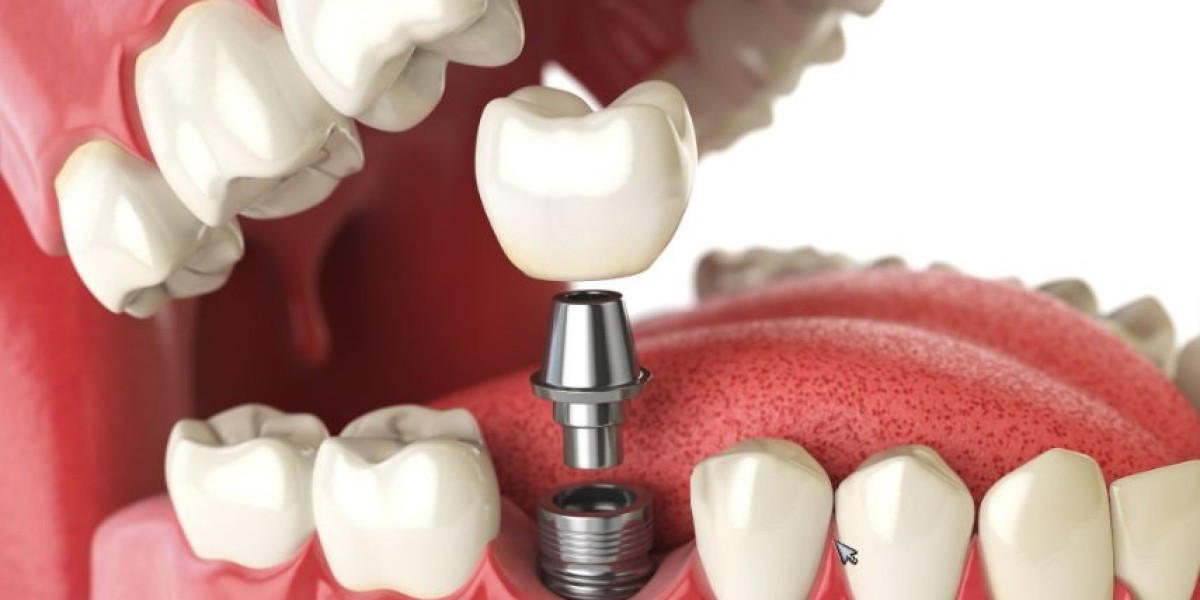 What Are Dental Implants and How Do They Work