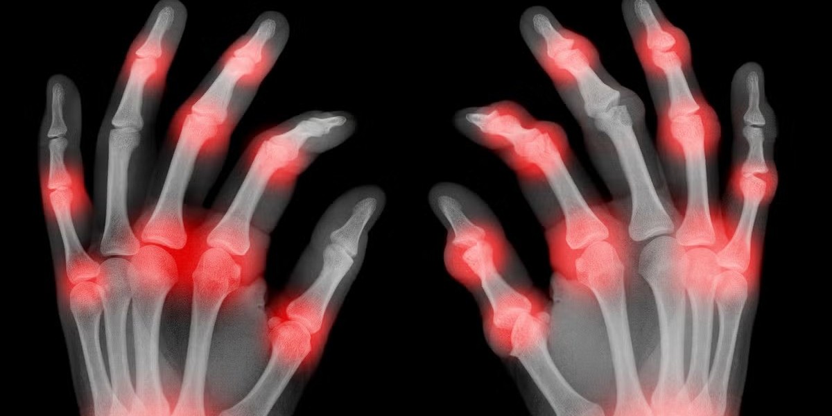 Arthritis Therapeutics Market: Demand for Advanced Therapies and Patient-Centered Care