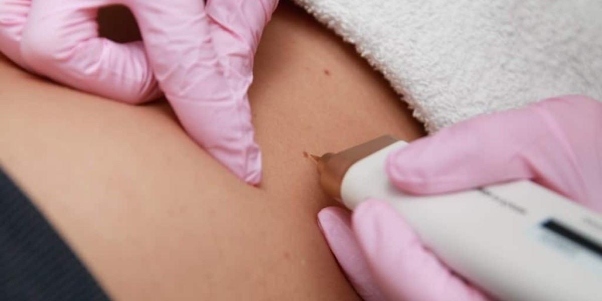 Is Skin Tag Removal Effective for Stubborn Tags?