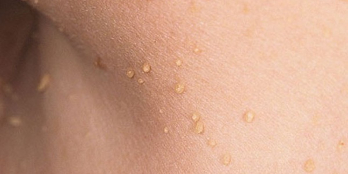 How Do You Treat Skin Tags in Children?