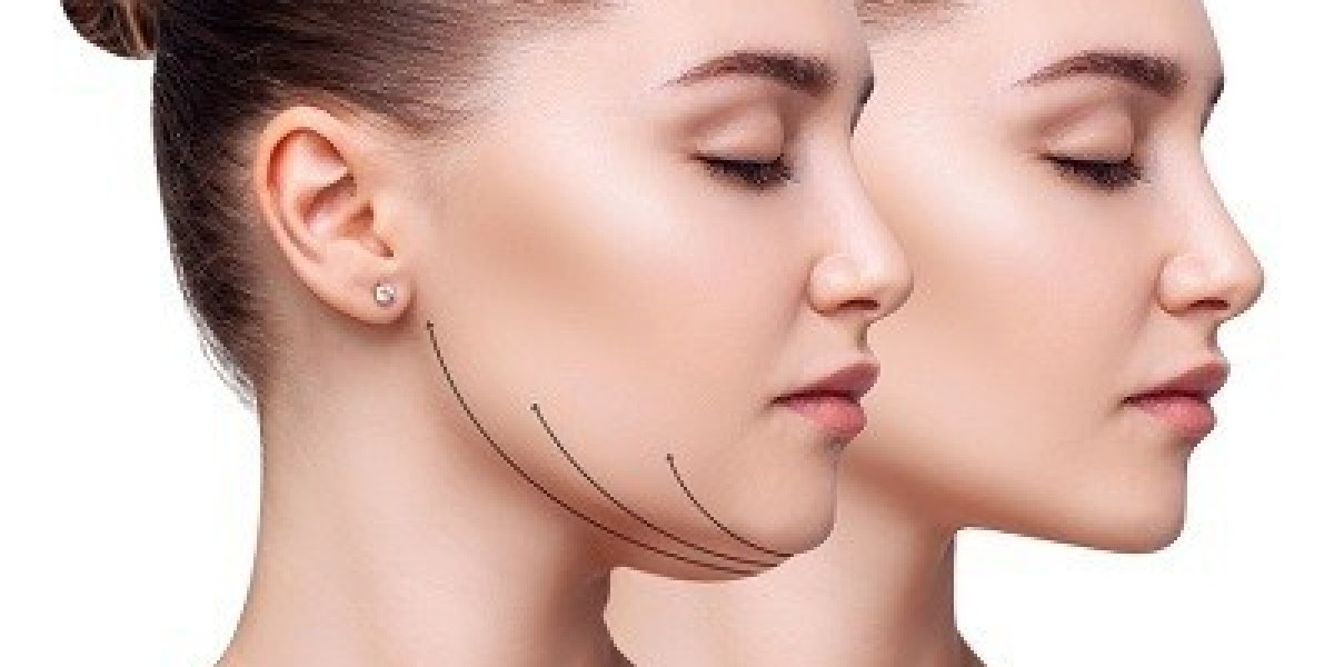 Get a Perfect Jawline with double Chin removal Treatments Islamabad
