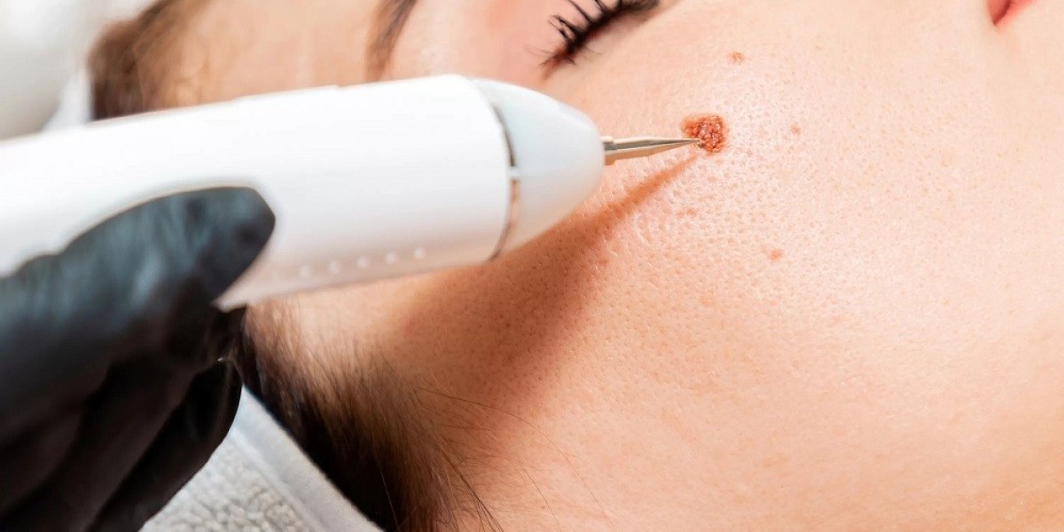 Experience Expert Mole Removal at Glamorous Clinic Islamabad