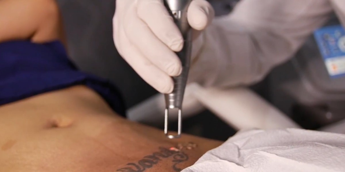 What Makes Laser Tattoo Removal the Best Choice in Dubai?