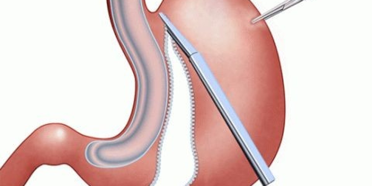 2025 Laparoscopic Sleeve Gastrectomy Cost in Riyadh Explained