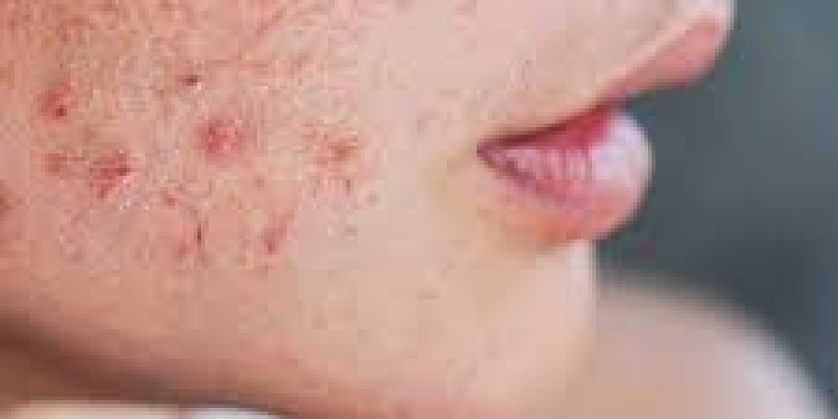 How to Treat Adult Acne: Effective Solutions for Clearer Skin