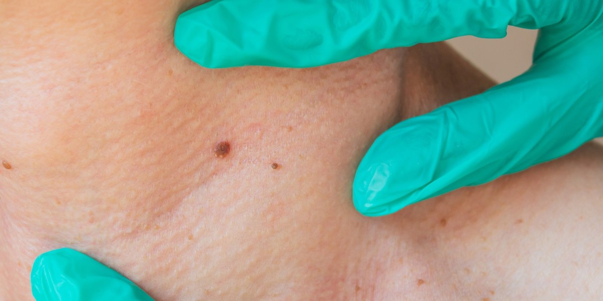 How Often Should You Consider Skin Tag Removal?