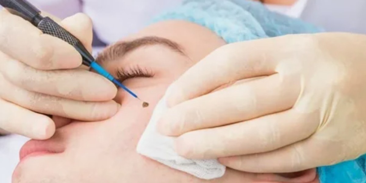 Top-Rated Laser Mole Removal Clinics in Riyadh