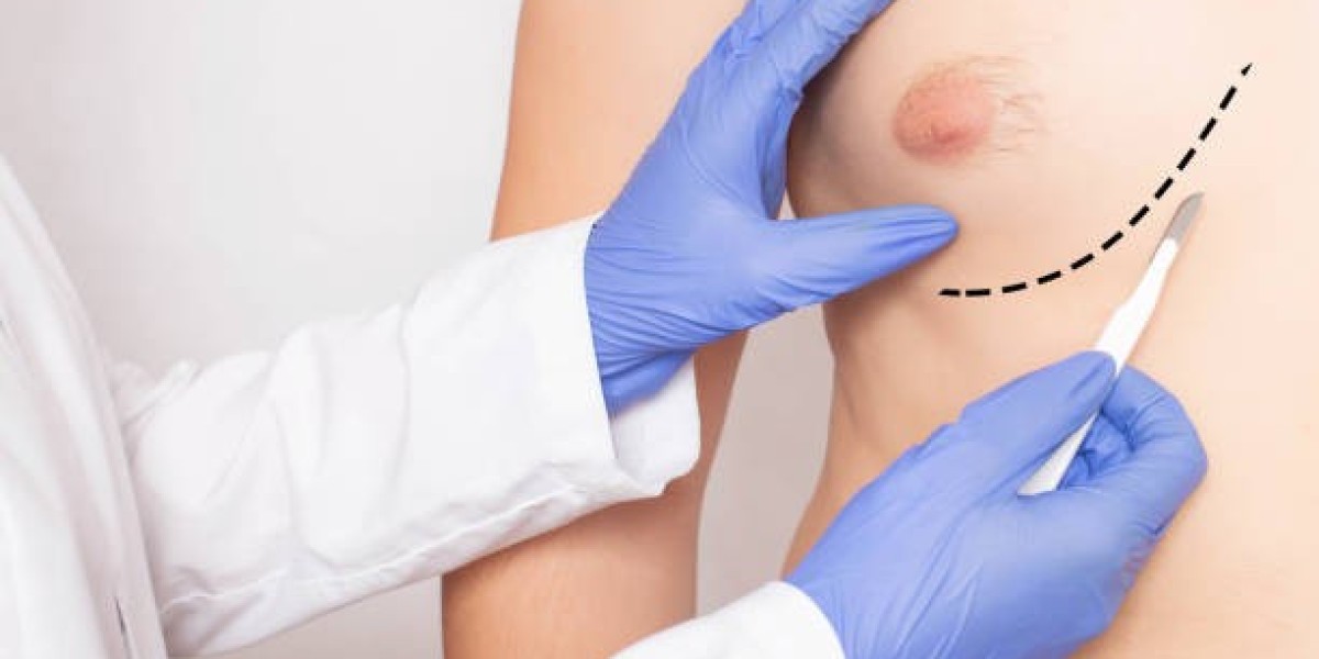 خطوات عملية لعلاج التثدي في الرياض بسهولة