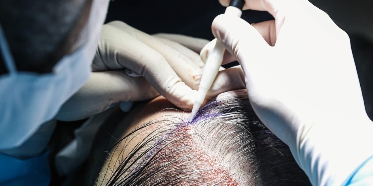 Who Should Avoid Hair Replacement in Dubai?