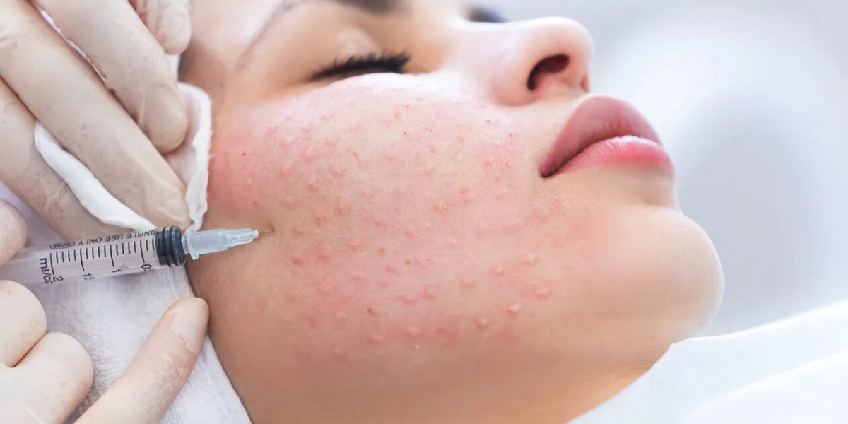 Where Are Skin Whitening Injections Most Affordable?