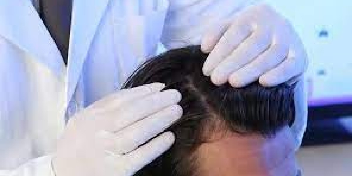 The Role of Finasteride in Hair Loss Management in Dubai