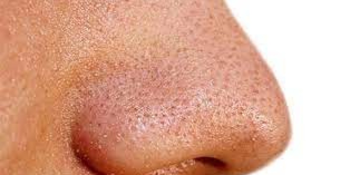 Understanding the Costs of Large Pores Treatment Options