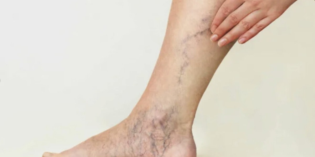 Expert Advice on Treating Varicose Veins in Riyadh