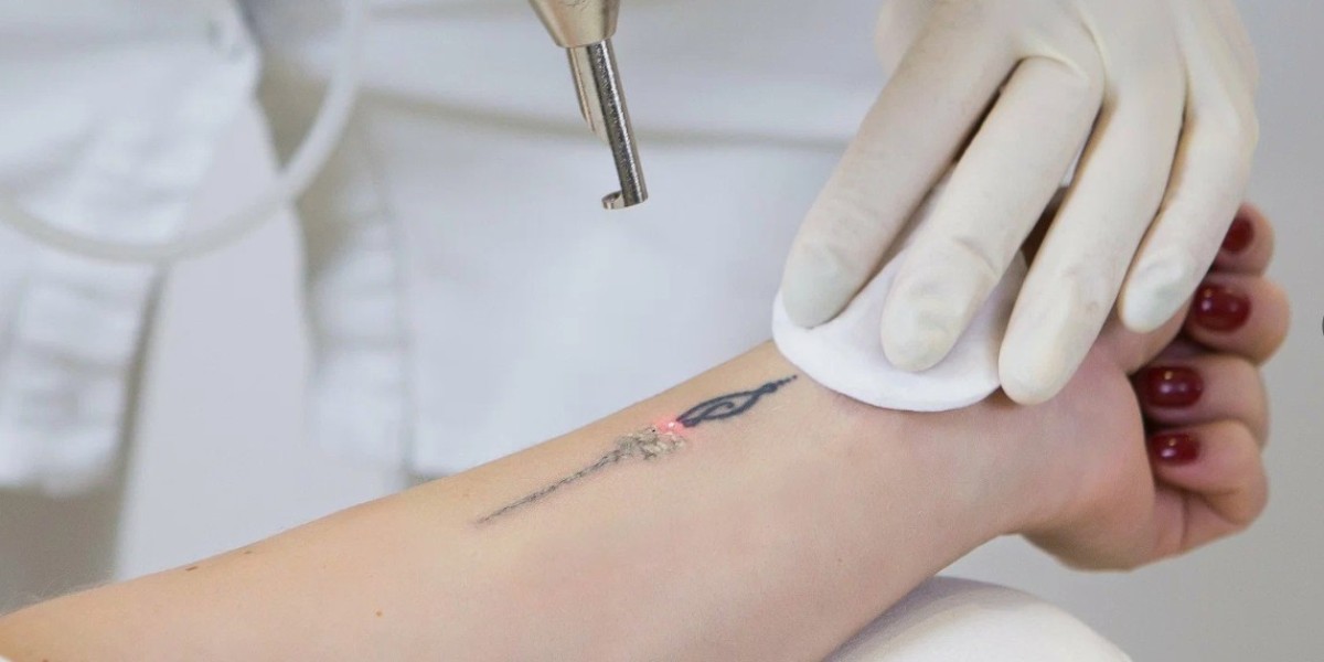 Choosing the Right Laser Technology for Tattoo Removal in Riyadh