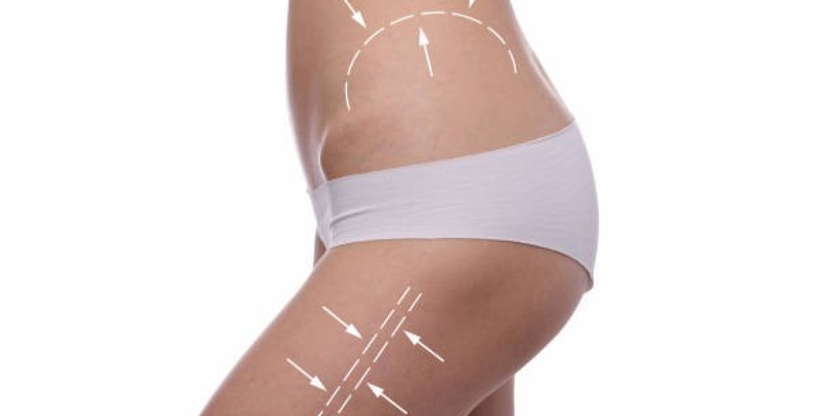Boost Your Confidence with 4D Vaser Liposuction in Riyadh