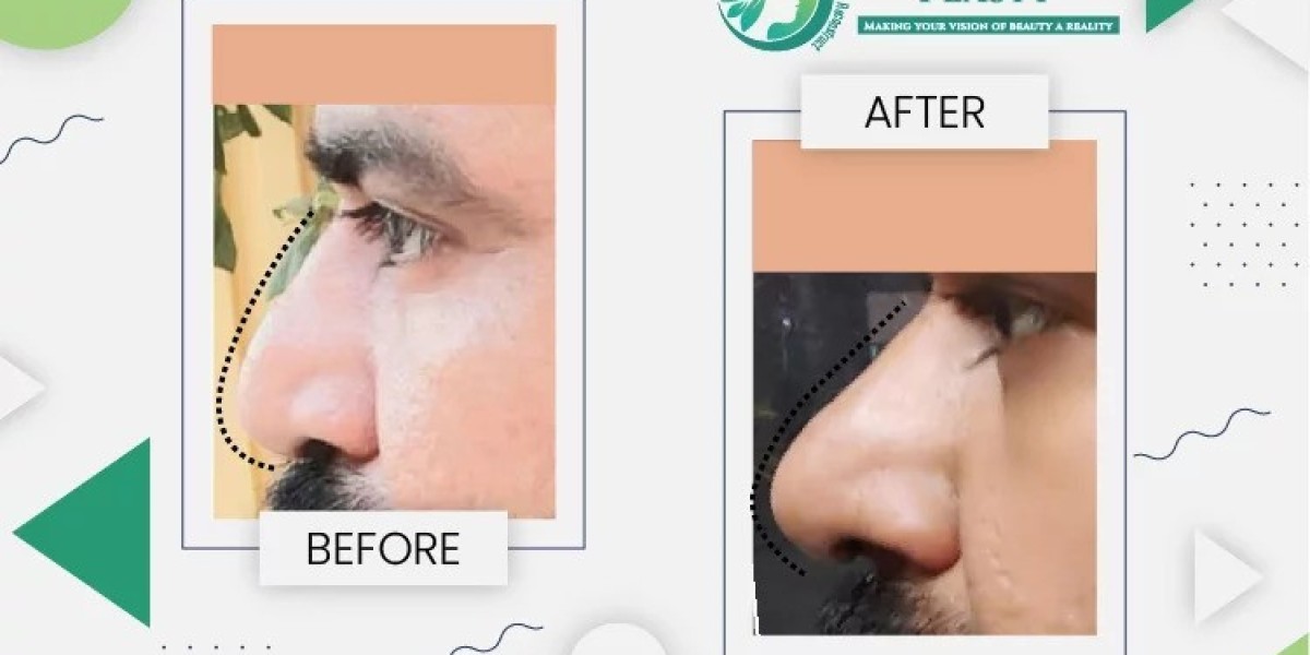 Finding the Best Rhinoplasty Surgeon in Lahore: A Comprehensive Guide