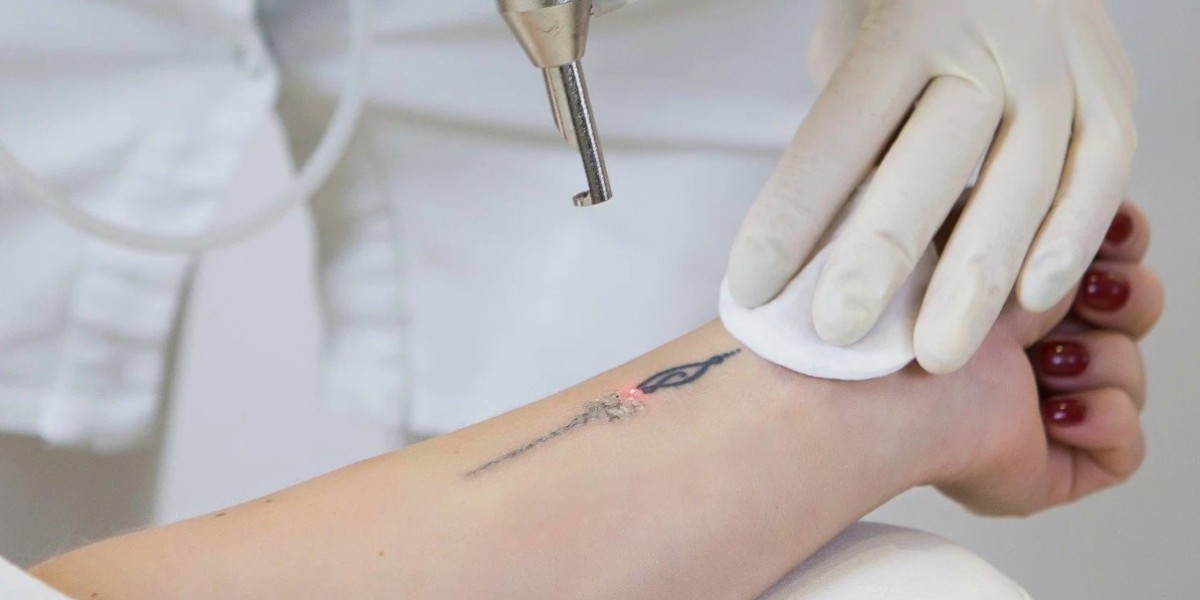 Tattoo Fading Services in Riyadh: Laser Options Explained