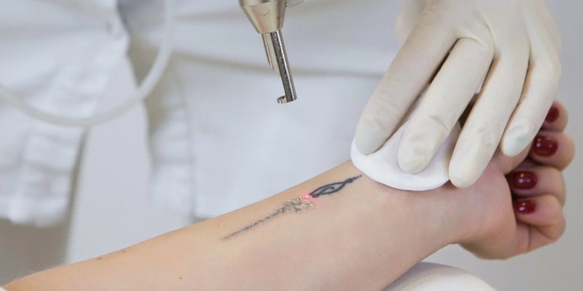 Expert Tips for Preparing for Laser Tattoo Removal in Riyadh