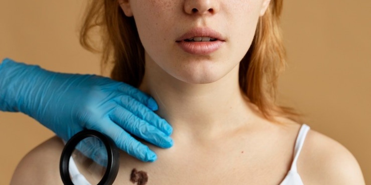 What is the best care after mole removal?
