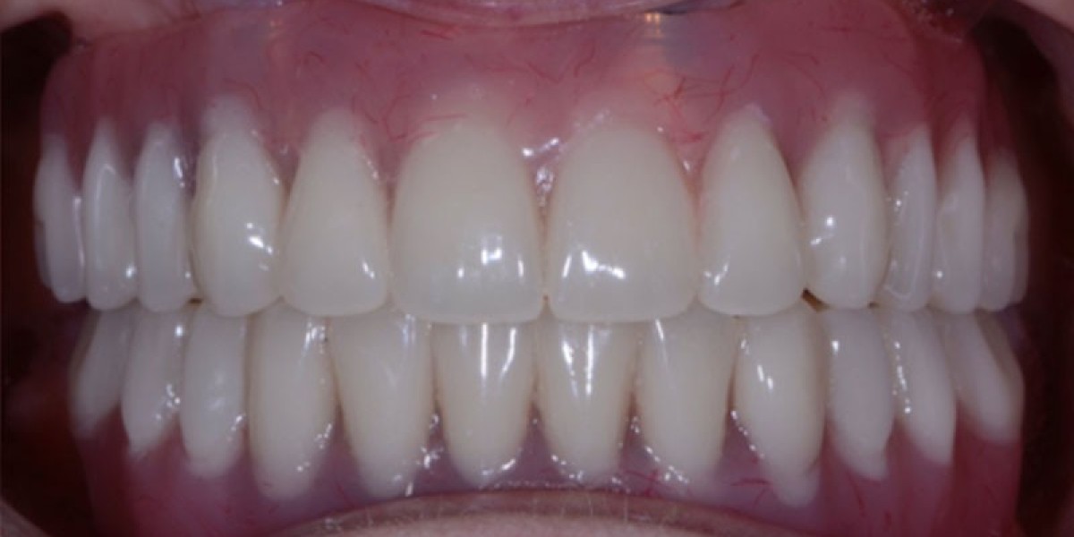 Budgeting for Full Mouth Dental Implants A Dubai Perspective