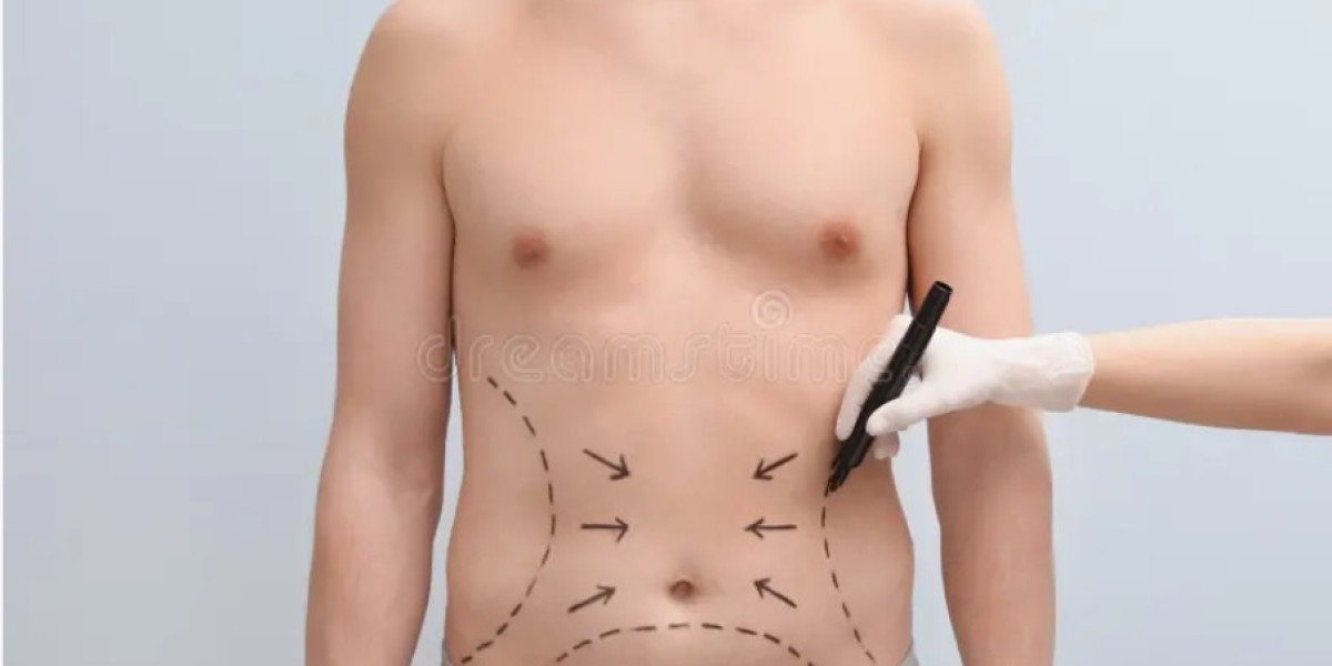 Benefits of Choosing VASER Liposuction in Riyadh for Fat Removal