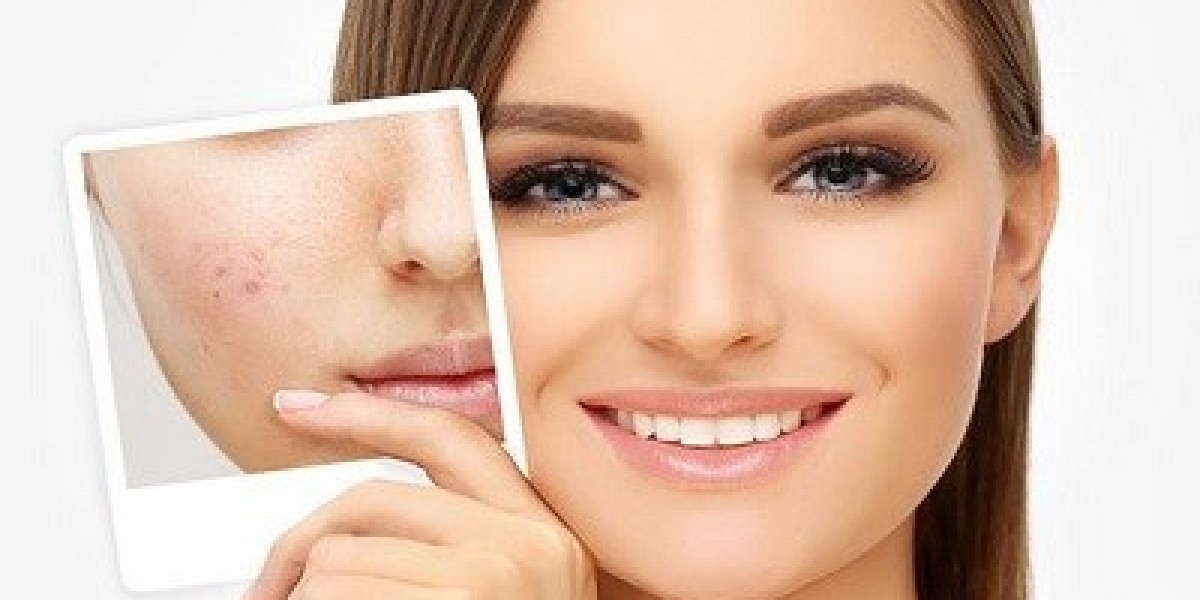 From Pimples to Perfection: A Step-by-Step Guide to Acne Treatment