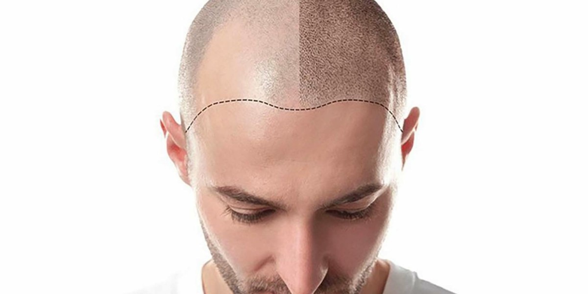 The Latest Innovations in Hair Transplant Technology in Riyadh