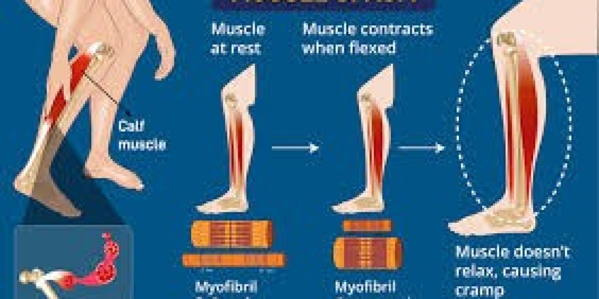 Understanding Muscle Spasms: Causes and Solutions