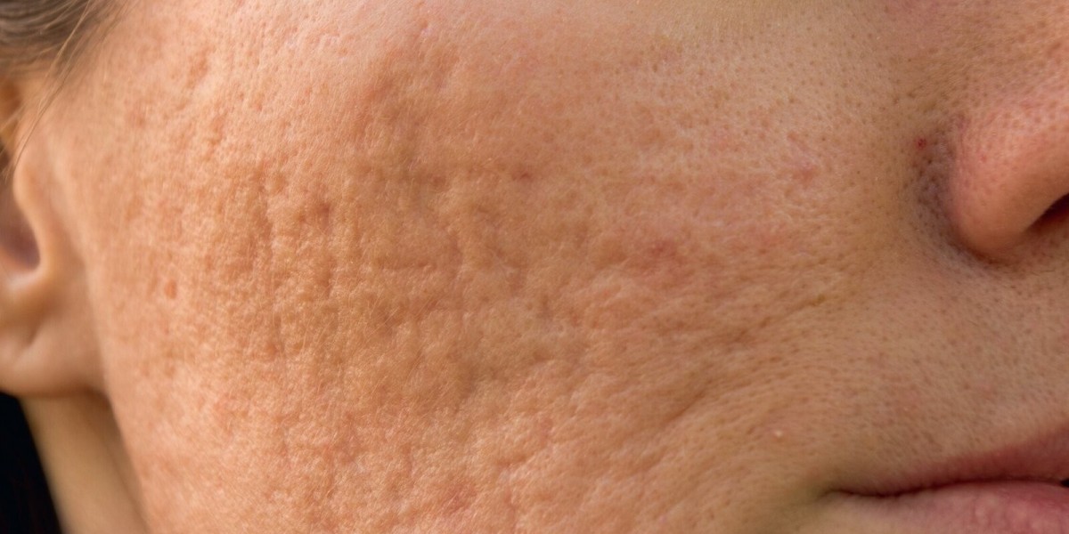Anti-Acne Dermal Patch Market Key Success Factors for New Entrants