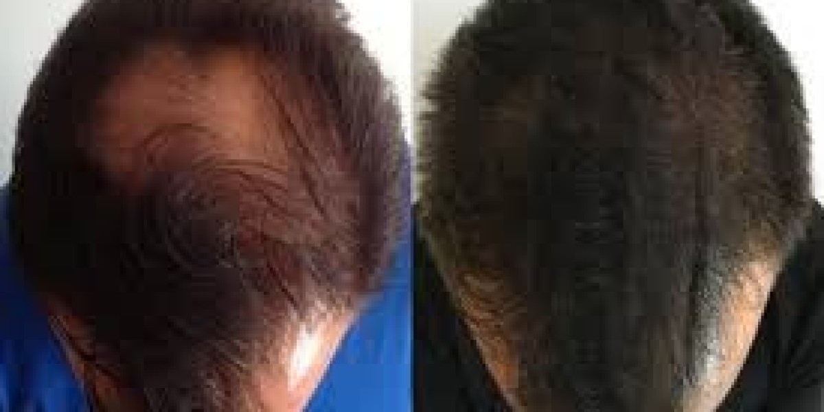The Science Behind Finasteride and Hair Regrowth