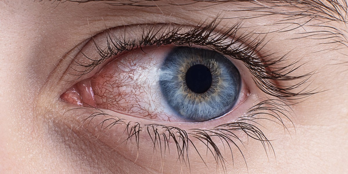 Dry Eye Syndrome Market: Exploring the Latest Innovations in Treatment and Monitoring