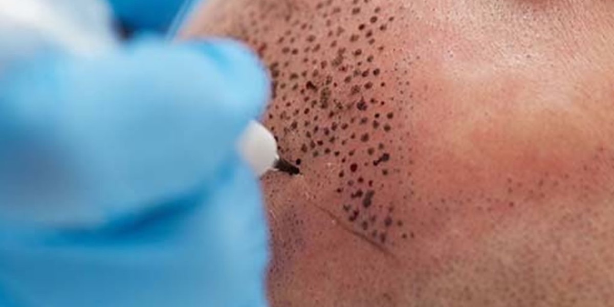 What Is the Best Age for Scalp Micropigmentation?